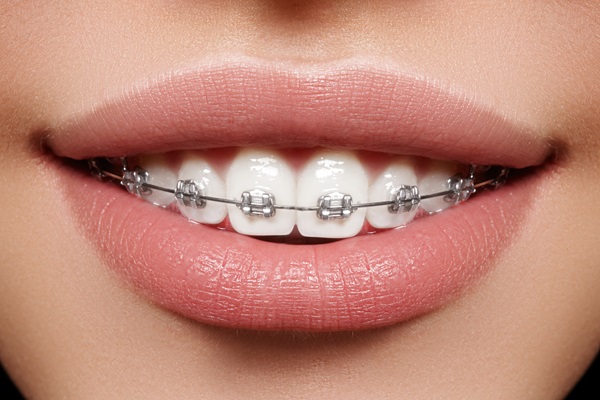 What Foods Are Off-Limits During Braces Treatment?