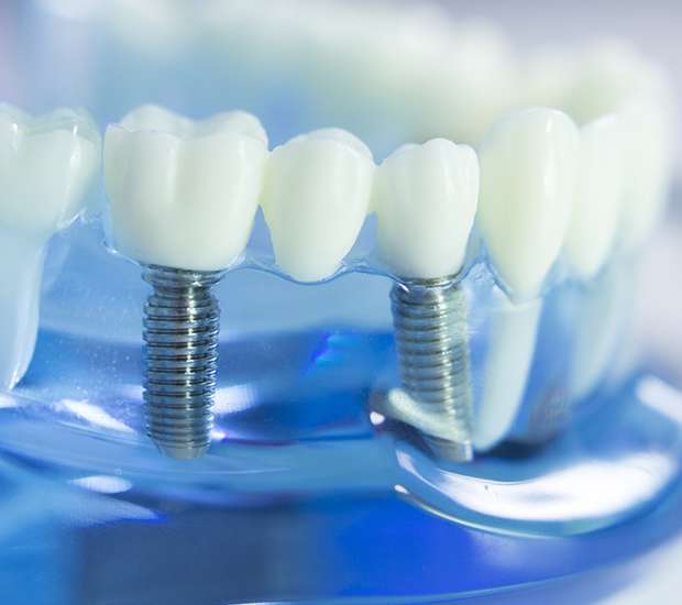 Hurst Dental Implants