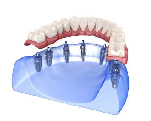 Implant Supported Dentures Hurst, TX